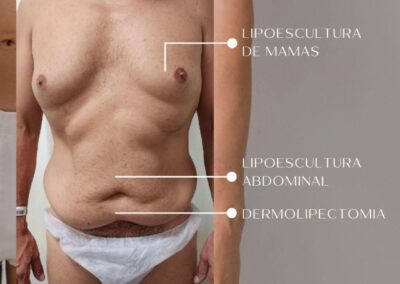 Abdominoplastia Masculina1