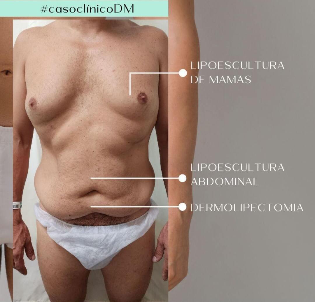 Abdominoplastia Masculina1
